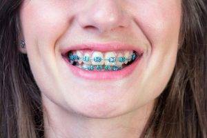 dental brace colored